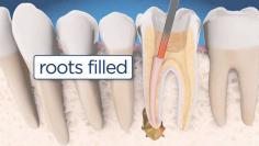 Root canal treatment to repair and retreatment save a badly damaged or infected tooth instead of removing it. We are the best root canal dentist in Santa Ana CA.
