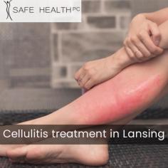 Safe Health Center in Lansing offers effective cellulitis treatment for individuals seeking professional care. Our experienced medical team utilizes advanced techniques and medications to alleviate symptoms, promote healing, and prevent complications. For more information visit our website. 