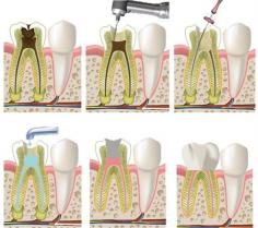 We specialize in maintaining teeth through dental endodontic treatment in Santa Ana CA. We offer high-quality dental care Treatment to both in Santa Ana CA.
