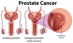 Prostate cancer treatment in Hyderabad has taken a diversion towards Ayurveda. Ayurvedic prostate cancer care by Punarjan Ayurveda combines individualized herbal treatments, dietary changes, lifestyle adjustments, and rejuvenation therapies to provide a holistic healing approach. These natural ways boost the immune system, lessen inflammation, and promote general health.