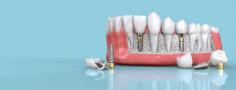 Dental implants are an alternative treatment to replace lost tooth/teeth. Dental implant surgery is recognized as standard treatment for a complete range.