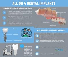 All On 4 Dental Implants