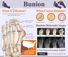 Do you have any questions about the no-scar bunion surgery procedure? You can finally stop searching for “bunion surgery near me” and schedule an appointment with an internationally recognized, top-rated bunion surgeon in NYC at Manhattan Foot Specialists. Do not wait any longer and contact our office for a consultation.

Manhattan Foot Specialists
Union Square
55 W 17th St STE 106,
New York, NY 10011
(212) 378-9991

Upper East Side
983 Park Avenue, Ste 1D14,
New York, NY 10028
(212) 389-1886
Web Address https://www.footdoctorpodiatristnyc.com
https://footdoctorpodiatristnyc.business.site/
E-mail info@footdoctorpodiatristnyc.com 

Our locations on the map:
Union Square https://goo.gl/maps/kea5dAUJenh1m85y5
Upper East Side https://goo.gl/maps/WjiEhPH6ydZxPGHfA

Nearby Locations:
Union Square
Gramercy Park | Rose Hill | Kips Bay | Nomad | Murray Hill | Koreatown
10010 | 10016 | 10453 | 10017

Nearby Locations:
Upper East Side
Yorkville | Manhattan Valley | Lenox Hill | Sutton Place | Carnegie Hill | East Harlem
10028 | 10025 | 10021| 10022 | 10029

Working Hours Union Square & Upper East Side:
Monday: 8AM - 7PM
Tuesday: 8AM - 7PM
Wednesday: 8AM - 7PM
Thursday: 8AM - 7PM
Friday: 8AM - 5PM
Saturday: Closed
Sunday: Closed

Payment: cash, check, credit cards.