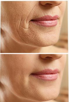 Dermal fillers are a non-surgical treatment that can add volume and contour to the face, smooth out wrinkles and fine lines, and enhance facial features. At Richmond Cosmetic & Laser, they offer a wide range of dermal fillers, including hyaluronic acid-based fillers like Juvéderm and Restylane, and collagen-stimulating fillers like Sculptra.