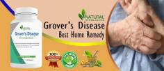 While home remedies, herbal therapies, and Natural Remedies For Grover's Disease can all provide relief from Grover's Disease symptoms, it's crucial to speak with a dermatologist before implementing any novel strategies.
