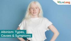 Learn about Albinism, an uncommon condition in which the skin, hair, or eyes have little or no color, It even causes vision related issues. Get more information on albinism causes and symptoms at Livlong.