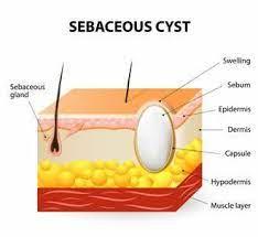 Effective Sebaceous Cyst Natural Treatments
There are some Natural Remedies for Sebaceous Cyst that may help alleviate symptoms and promote healing
https://jobhop.co.uk/blog/285952/effective-sebaceous-cyst-natural-treatments
