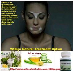 Aloe vera gel can be used both internally and externally. Aloe vera is one of the useful Herbal Remedies for vitiligo. Aloe vera has been known to soften and heal the skin and make the spots fade away.
