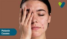 Learn about the many causes of melanin illness, which causes your skin to darken. Visit Livlong for more information about melanin deficiency.