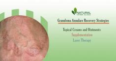 There are many Granuloma Annulare Recovery Strategies that can help reduce the appearance of the condition. Common treatments for Granuloma Annulare include topical creams and ointments, laser therapy, and medications.

