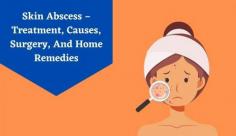 Explore a complete guide to abscess treatment with home remedies & surgery for the face, chest, Etc. Read more about how to treat abscesses at home at Livlong.