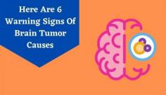 Explore details on brain cancer symptoms which is primarily caused by high exposure to radiation. Learn more about the signs of brain tumor at Livlong.