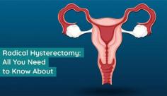 Find in-depth information on four types of radical hysterectomy and the need for it. Visit Livlong for more details on radical hysterectomy.