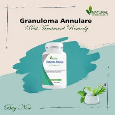 Looking for safe and effective ways for Natural Granuloma Annulare Care? Learn more about natural treatments and remedies that can help you manage the condition.
