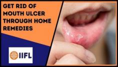 Discover the top 10 home remedies to cure mouth ulcers fast. Learn about Mouth ulcers, how long they persist and the causes of mouth ulcers. Keep reading to know more.