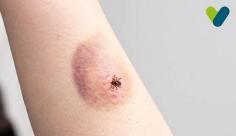 Everything you require to know about Tick bites, its types, symptoms and treatment. Keep reading this blog for information on common symptoms of tick bites like flammation, soreness of the skin or skin color change and more.