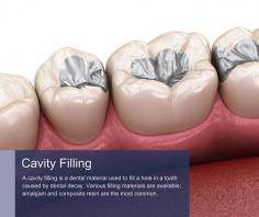 Who Might Need a Cavity Filling?
Anyone can develop tooth decay and need a dental filling. However, certain conditions can increase the risk of cavities. These include eating too many sugary or starchy foods, especially between meals, poor oral hygiene, and dental problems like dry mouth. Good preventive dental care can greatly reduce these risks, and when you first visit Century Dental, we assess your risk of dental problems, including cavities.

We can then devise your custom preventive dental care plan. This will include the frequency of dental checkups and hygiene appointments, and we can work closely with you to ensure your daily oral care routine is excellent. If you need a cavity filled, we can provide the most appropriate dental care, using the best techniques and materials to restore the tooth.

What is a Cavity Filling?
A cavity filling is a dental material used to fill a hole in a tooth caused by dental decay. Various filling materials are available; amalgam and composite resin are the most common.

Amalgam fillings have been used for over a century and contain mercury and other metals. They are durable and long-lasting but are highly visible when smiling and therefore tend only to be used when restoring cavities in back teeth.

Composite resin fillings are newer and are tooth colored, making them virtually invisible. Composite resin is reasonably durable and ideal for restoring cavities in front teeth or anywhere in the mouth. The material can be used to repair small to medium-sized cavities.

Amalgam vs. Composite
Amalgam fillings are reliable but are less widely used, and many dental offices are amalgam free as this material is gradually being phased out. Their decline in popularity is due to the introduction of newer, more biocompatible materials like composite resin and concerns about mercury content in amalgam.

Composite resin is a more popular choice for restoring a tooth cavity, not just because it is tooth-colored. The material requires less tooth preparation than amalgam fillings so that we can preserve more of the healthy tooth structure. Composite resin doesn’t flex when it comes under pressure or when exposed to temperature changes in the mouth, for example, when you eat something hot or cold.

Instead, the material closely mimics natural tooth structure and will bond strongly to your tooth, forming a good seal that helps to prevent further infection. Amalgam can flex slightly when subjected to pressure or temperature changes, eventually causing microfractures in teeth that can weaken them over time.

If you have older amalgam fillings and are wondering if they should be replaced, we can assess their condition during your next checkup at Century Dental. No filling lasts forever, and when the time comes, we can ensure that any amalgam fillings are removed safely, and the amalgam is disposed of correctly so it will not harm the environment.

Read more: https://www.centurymedicaldental.com/dentistry/cavity-filling/

Century Dentistry Center
827 11th Ave Ground Floor
New York, NY 10019
(212) 929-2202
Web Address https://www.centurymedicaldental.com/dentistry/

Our location on the map: https://maps.app.goo.gl/34T4HmeGp73S6pFQ8
https://plus.codes/87G8Q2C5+27 New York

Nearby Locations:
Hell's Kitchen | Upper West Side | Midtown West | Chelsea | Midtown East | Little Brazil
10036 | 10023, 10024, 10025, 10069 | 10019 | 10001, 10011 | 10022

Working Hours:
Monday- Friday: 9:00 am - 6:00 pm
Saturday: 9:00 am - 4:00 pm
Sunday: Closed

Payment: cash, check, credit cards.