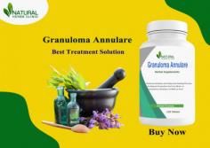 Discover helpful tips for Granuloma Annulare Control to reduce discomfort and promote healing, including lifestyle changes and medications.
