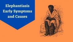 Discover the signs and symptoms of elephantiasis or lymphatic filariasis is a rare condition that’s spread by mosquitoes. Know more about elephantiasis & early symptoms at Livlong.