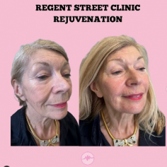 We have a 15-year history of providing the latest treatment in anti-ageing medicine.

Know more: https://www.regentstreetclinic.co.uk/facial-aesthetics/