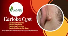 Living with an earlobe cyst can be uncomfortable and embarrassing. Fortunately, there are simple steps you can take Earlobe Cyst Removal at Home without the need for a doctor’s visit. From choosing the right products to understanding the removal process, here is how you can remove an earlobe cyst from your own home.
