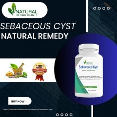 Obtain Knowledge about the amazing healing properties of Aloe Vera for Sebaceous Cysts treatment. Discover the benefits of using this natural remedy and why it is considered an effective treatment option.
