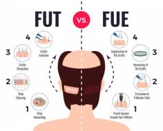 Difference between FUE Vs FUT hair transplant
The most popular types of surgical hair transplants are Follicular Unit Transplantation (FUT) and Follicular Unit Extraction (FUE).