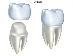 Visit Lynnwood Dental Studio for affordable dental crowns in Lynnwood WA,at a reasonable price. https://www.lynnwooddentalstudio.com/crowns-bridges