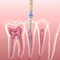 Root canal treatment, also referred to as endodontic therapy, is a treatment used to remove the inﬂamed or infected nerve from a tooth. 