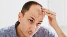 Losing hair in the middle? Experience effective Male Pattern Hair Loss treatments at Aroga Pharmacy in Farnham Common and surrounding areas. Book a consultation today.