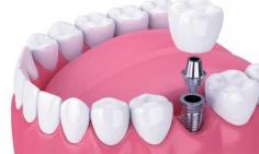  When to Consider Dental Implants: Exploring Options for Tooth Replacement
Are you missing one or more teeth? Dental implants are a great option for tooth replacement. Explore the various factors to consider when deciding if dental implants are right for you.
https://www.mindfuldentist.london/