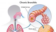 BronchiectasisNatural Remedies for Bronchiectasis have an important role to play in the long-term management and Herbal Treatment for Bronchiectasis. Herbal supplements are known to have a specific action on the mucosa of the respiratory tract as well as the muscular walls of the airways in the lungs. These medicines have an anti-inflammatory effect and decrease inflammation, congestion and the creation of too many fluids in the lungs. Natural Treatment for Bronchiectasis also reduces the damage to the airways and brings about an important reversal in the dysfunction caused due to this damage.
