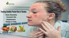 How to treat Reddish Peeled Kind of Rashes effectively with this essential guide for skin health. Get tips on prevention and Treatments.
