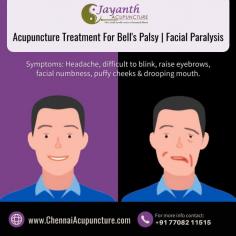 Acupuncture treatment For Bell’s Palsy or Facial Paralysis in Chennai. Facial palsy or Bell’s palsy (முக வாதம்) is when all the muscles on one side of the face suddenly weaken and become inactive. 