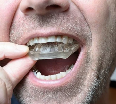 Get custom mouthguards in Gosnells for optimal protection during sports and physical activities. Quick Denture Repair offers professional, personalized mouthguards tailored to fit your mouth perfectly, ensuring comfort and safety. Don't compromise on oral protection—trust Quick Denture Repair for reliable custom mouthguards in Gosnells.
https://quickdenturerepair.com.au/customised-sports-mouthguards-occlusal-splints/