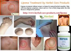 Following are some Herbal Treatment for Lipoma performing different functions. Home Remedies for Lipoma may help reduce or eliminate a lipoma; however, always check with your doctor before using a natural approach.