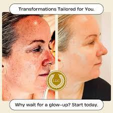 The fractional micro ablative CO2 laser skin resurfacing treatment is the international gold standard for skin resurfacing. 

https://llccosmetic.com/pages/laser-skin-resurfacing 

#llccosmetic #laserskinresurfacing #laserskinresurfacingbrisbane