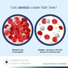 Yes, anemia can cause hair loss. Here's a breakdown of the why and how:

Iron Deficiency: The most common type of anemia is iron deficiency anemia. Iron is a mineral essential for producing hemoglobin, a protein in red blood cells that carries oxygen throughout the body.

Oxygen Deprivation: When you have iron deficiency anemia, your body doesn't have enough red blood cells or hemoglobin. This means your hair follicles, which need oxygen to function properly, may not be getting the oxygen they need for healthy hair growth.

Hair Growth Disruption: Due to the lack of oxygen, hair growth can slow down or stop altogether. This can lead to hair thinning and shedding, eventually resulting in noticeable hair loss.

The severity of the anemia and the duration of the deficiency can influence the likelihood of hair loss. Other factors like genetics, overall health, and nutritional deficiencies can also play a role.

Anemia can be diagnosed by performing a blood test and determine the underlying cause (iron deficiency or other type).

Anemia can be a contributing factor to hair loss, but it's not the only cause. If you're experiencing hair loss, consult our hair loss experts in Ailesbury Hair Clinic to determine the underlying reason and get the appropriate treatment.

Visit website: https://www.ailesburyhairclinic.ie/
