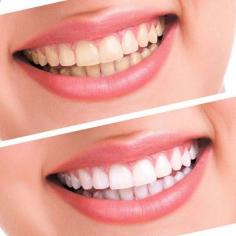 We offer the best teeth whitening treatments in Seattle WA. We provide the best teeth bonding and dental cosmetic bonding in Seattle WA. Call: 206-365-5060
