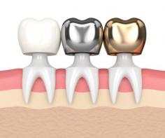 Our clinic proudly offers the latest technology in the best dental crown treatments in Seattle, WA. We specialize in using the best dental crowns in Seattle, WA
