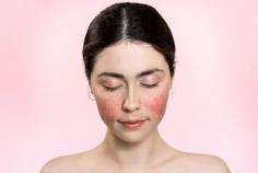 Experience the benefits of rosacea laser treatment in Brisbane. Reduce redness and irritation for a smoother complexion. Book your consultation now! 

https://llccosmetic.com/pages/laser-treatments-for-rosacea 

#RosaceaLaserTreatmentBrisbane, #SkinCare ,#LaserTherapy, #Llccosmetic