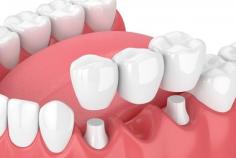 We offer high-quality best bridge dental to replace missing teeth and wisdom tooth extraction, including wisdom tooth removal in Seattle, WA. Call: 206-365-5060
