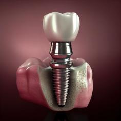 Dental & Denture Clinic offers the best dental implants in Seattle, WA. We offer same-day dental implant surgery for qualifying patients in Seattle, WA
