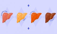 Liver Cirrhosis Explained: 5 Things Doctors Advise | Fluent Health

Read the FLuent Health blog for insights on liver cirrhosis - understand its impact, manage its symptoms, and learn ways to prevent this disease at  https://fluentinhealth.com/blog/5-things-doctors-want-you-to-know-about-liver-cirrhosis
