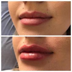 Our doctors have over 20 years experience in lip augmentation procedures and offer a subtle plumping of lips to leave a full-bodied, youthful appearance.

Know more: https://www.regentstreetclinic.co.uk/facial-aesthetics/