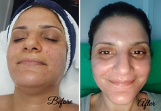 Transform Your Skin with Cutting-Edge Laser Skin Resurfacing

Discover the benefits of laser skin resurfacing to diminish wrinkles, scars, and sun damage. Achieve smooth, radiant skin with our expert treatments.

https://llccosmetic.com/cdn/shop/files/Before_860a8bd0-f66e-4771-9b7f-9f093426b346.png?v=1675228124

#LLCCosmetic #LaserSkinResurfacing #RadiantSkin #SkinCareRevolution #BrisbaneClinic