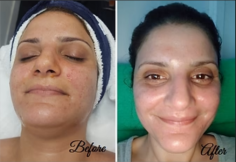 Effective CO2 Laser Resurfacing - LLC Cosmetic Laser Clinic

LLC Cosmetic Laser Clinic offers effective CO2 laser resurfacing. Our advanced treatment smooths wrinkles, scars, and skin imperfections, rejuvenating your appearance. Book a consultation today. 


https://llccosmetic.com/cdn/shop/files/Before_860a8bd0-f66e-4771-9b7f-9f093426b346.png?v=1675228124

#CO2Laser #SkinRejuvenation #YouthfulSkin #LlcCosmetic #BrisbaneClinic