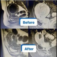 Explore before and after pictures of fibroid removal to understand the effectiveness of various treatments. Learn how fibroid removal can transform your health and well-being through real-life visual examples. Discover the benefits and outcomes of fibroid treatment options.