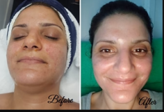 CO2 laser skin resurfacing treatment in Brisbane

At LLC Cosmetics in Brisbane, we use CO2 fractional laser resurfacing to treat a variety of skin conditions ranging from a mild rejuvenation to an aggressive treatment approach, depending on condition severity and required results.

https://llccosmetic.com/pages/laser-skin-resurfacing

#CO2Laser, #SkinRejuvenation, #YouthfulSkin ,#LlcCosmetic, #BrisbaneClinic
