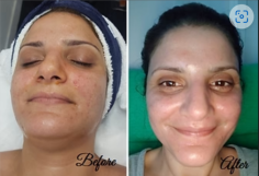 Transform Your Skin with CO2 Laser Resurfacing

Experience the transformative effects of CO2 laser resurfacing. This advanced treatment reduces wrinkles, scars, and sun damage, rejuvenating your skin for a youthful appearance.
 https://llccosmetic.com/cdn/shop/files/Before_860a8bd0-f66e-4771-9b7f-9f093426b346.png?v=1675228124

#CO2Laser #SkinRejuvenation #YouthfulSkin #LlcCosmetic #BrisbaneClinic